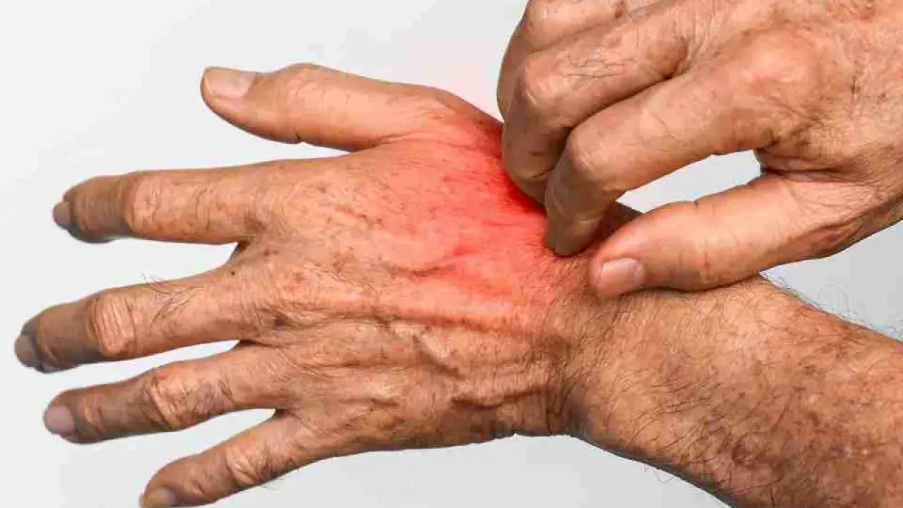 Mano che si gratta, con arrossamento e irritazione, sintomi tipici di cos'è la rogna.