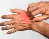 Mano che si gratta, con arrossamento e irritazione, sintomi tipici di cos'è la rogna.