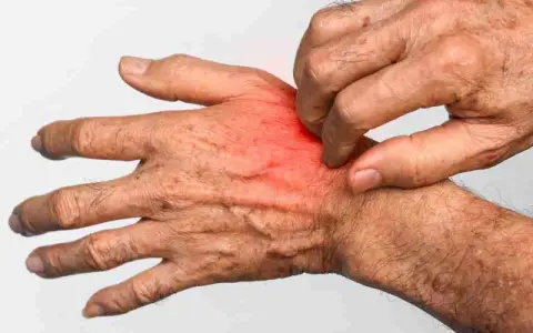 Mano che si gratta, con arrossamento e irritazione, sintomi tipici di cos'è la rogna.