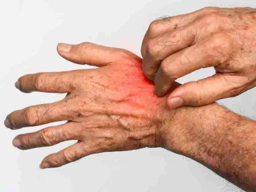 Mano che si gratta, con arrossamento e irritazione, sintomi tipici di cos'è la rogna.