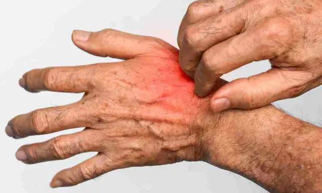 Mano che si gratta, con arrossamento e irritazione, sintomi tipici di cos'è la rogna.