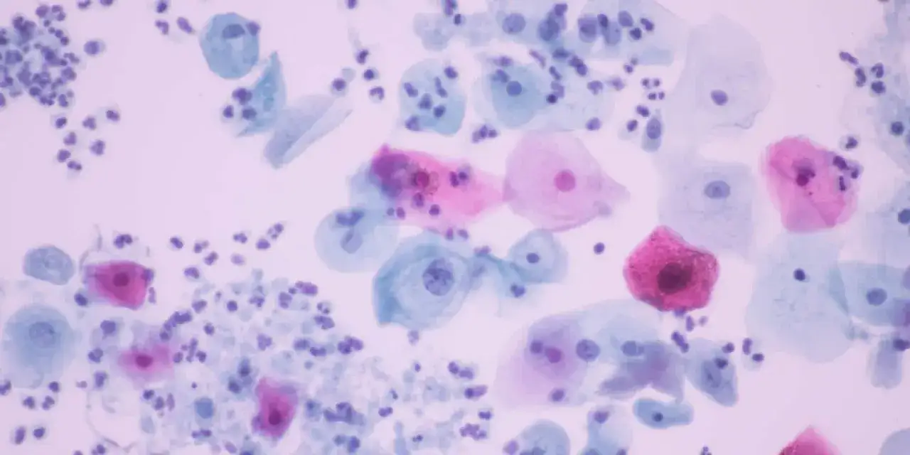 Cellule epiteliali con nuclei visibili e piccoli organismi viola, forse indicativi di tricomoniasi cura.