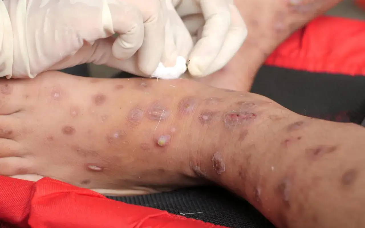Piedi e gambe con lesioni cutanee, pustole e croste, indicative di cos'&egrave; la rogna. Mani con guanti bianchi applicano un trattamento.